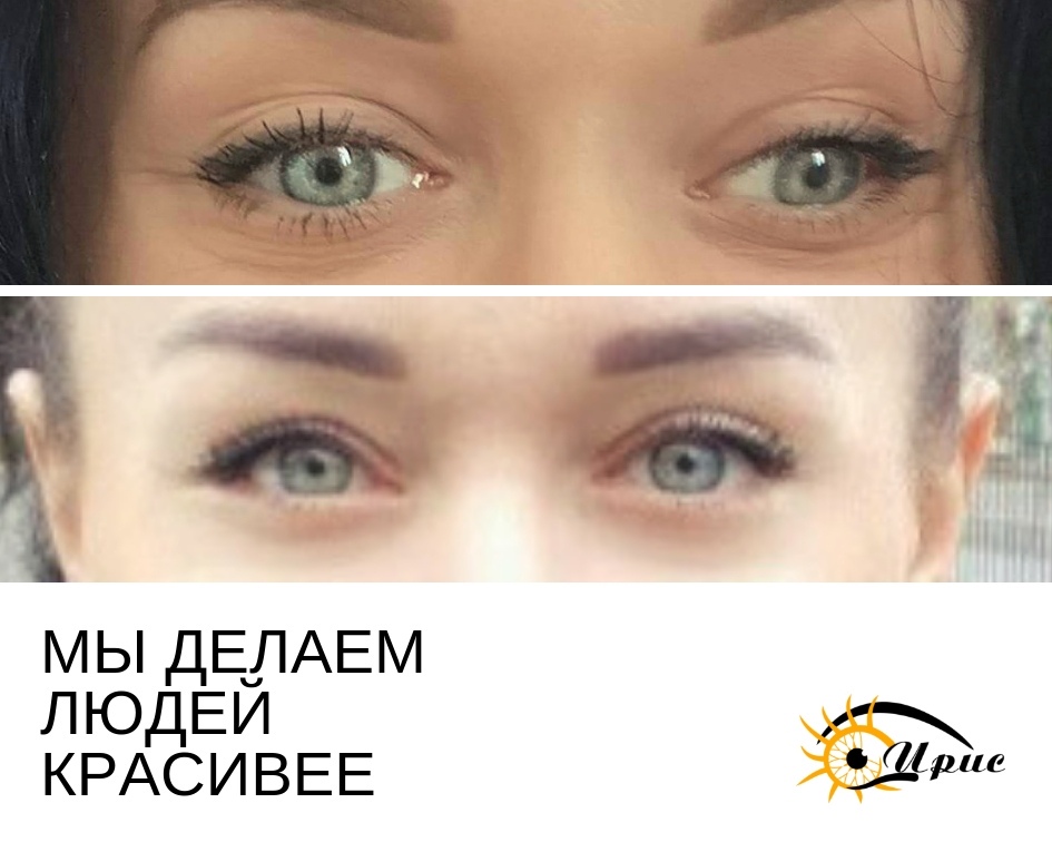 косоглазие.jpg косоглазие.jpg